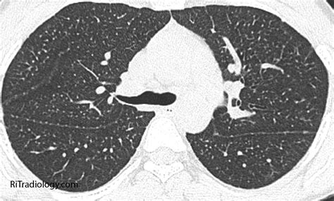 RiT radiology: Miliary Tuberculosis