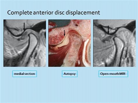 The Tempromandibular Joint (TMJ) normal anatomy and Pathology with ...