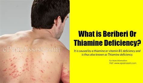 What is Beriberi or Thiamine Deficiency|Causes|Symptoms|Treatment|Home Remedies|Prognosis|Prevention