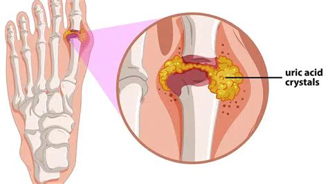 Gout - Carolina Regional Orthopedics