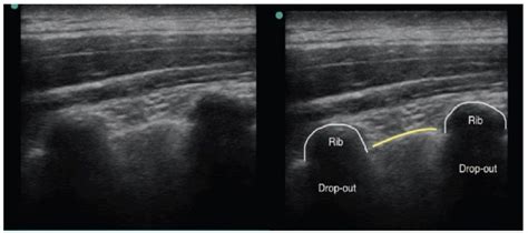 Ultrasound-Guided Paravertebral Block : WFSA - Resources