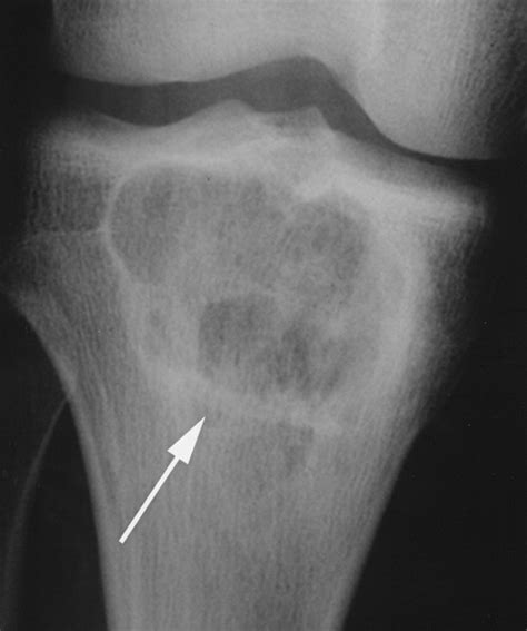 Mimics on Radiography of Giant Cell Tumor of Bone | AJR