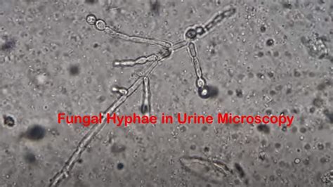 Urine Under The Microscope Showing Hyphae Indicates Fungal, 58% OFF