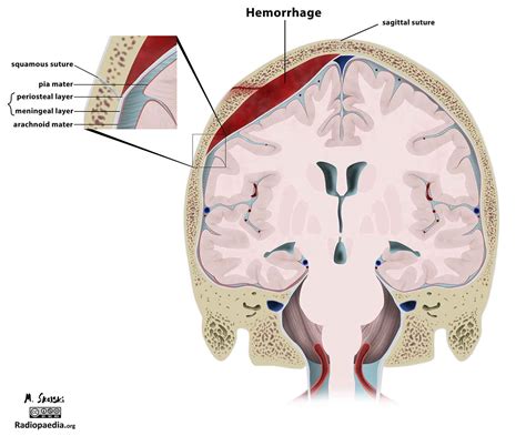 Subarachnoid Hematoma Vs Subdural Hematoma