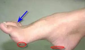 CAVUS FOOT-Causes, Symptoms, Treatment