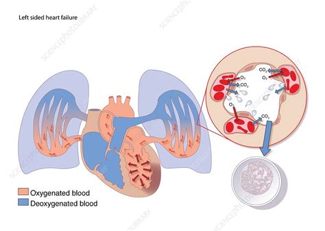 Left-sided heart failure, artwork - Stock Image - C009/0471 - Science Photo Library