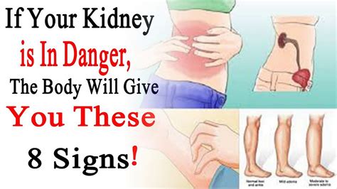 How To Detect Kidney Failure Early Kidney Disease Detection Treatment ...