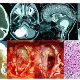 Pilocytic astrocytoma cerebellum of a 22-year-old male is depicted by ...