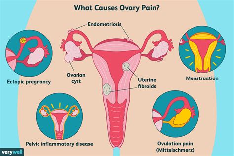 Ovary Pain: Causes, Treatment, and When to See a Healthcare Provider