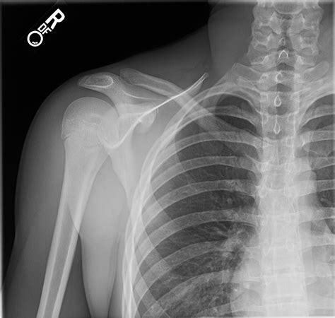 Sternoclavicular Dislocation