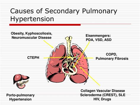 PPT - PAH and Lung Transplant PowerPoint Presentation, free download - ID:489420