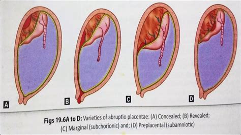 Antepartum Haemorrhage (APH), cause and management - Vaidyaनमः