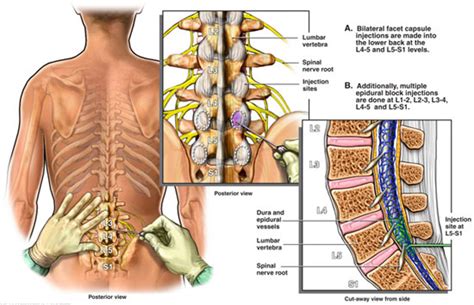 Back Pain Spine Specialist Doctor | Singapore Sports and Orthopaedic Clinic - Neurosurgeon