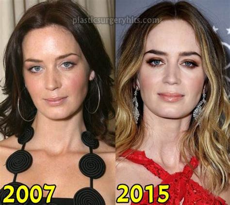 Emily Blunt Plastic Surgery Before and After Nose Job and Breast ...