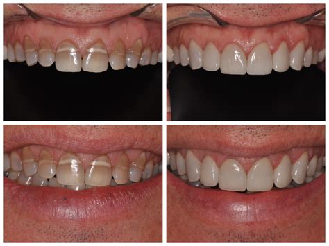 Smile Spotlight: David | Transform Tetracycline Stains on Teeth