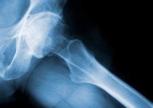 Natural Calcium for Osteopenia - The Healthy Hive - The Healthy Hive