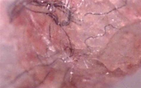 Morgellons Disease - AllergyKB