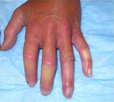 What causes cold hands? – What causes this?