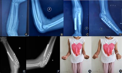 | (A,B) A 7-year-old girl who had right proximal radioulnar synostosis ...