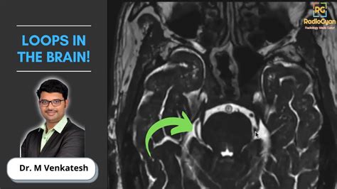 Imaging of Neurovascular Conflict (Trigeminal Neuralgia) | Dr ...