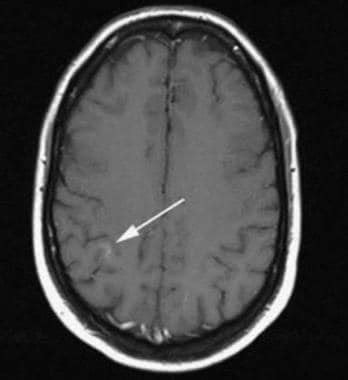 Capillary Telangiectasia Brain Imaging: Practice Essentials, Magnetic Resonance Imaging