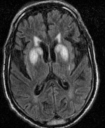 Hypoglycemic Encephalopathy-MRI - Sumer's Radiology Blog