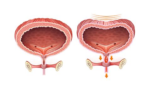 Female Dysfunctions: Bladder Disorders – Pelvic Physiotherapy