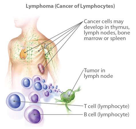 Learn About Non Hodgkin Lymphoma Information Facts Overview | Hot Sex ...