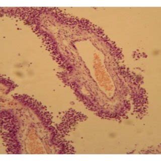 Histology of the tumor showing papillary projections (a) based on ...