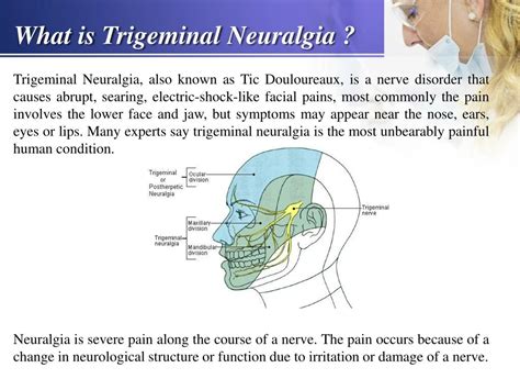 PPT - Trigeminal Neuralgia - Causes, Symptoms, Prevention and Treatment - Biogetica PowerPoint ...