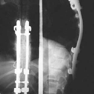 1 An example of a non-segmental fusion tech- nique(Harrington Rod ...