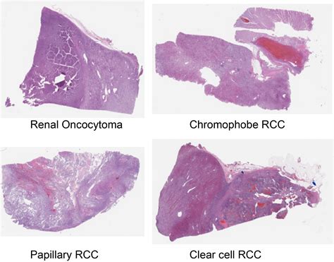 Dartmouth Kidney Cancer Histology Dataset