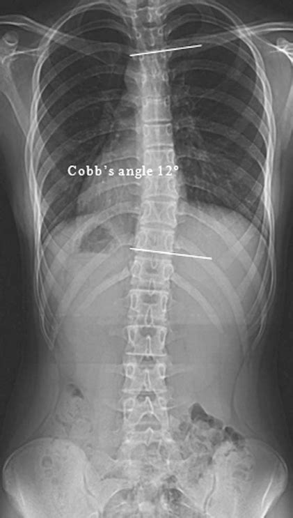 Mild Scoliosis X Ray