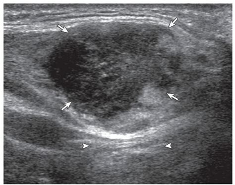 Neck Lipoma Ultrasound Images - Infoupdate.org