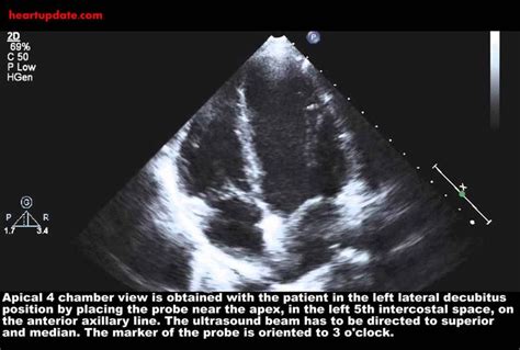 Echocardiography: Apical 4 Chamber View (AP4CH) - HeartUpdate.com ...