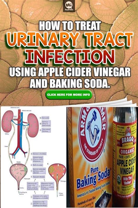 HOW TO TREAT URINARY TRACT INFECTION USING APPLE CIDER VINEGAR AND BAKING SODA. | Apple cider ...