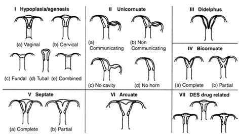 Bicornuate Uterus with Hematometrocolpos and Hydrosalpinx – RADIOLOGYPICS.COM