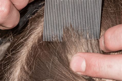 Lice vs. Dandruff - A Complete Guide - Bullock's Buzz