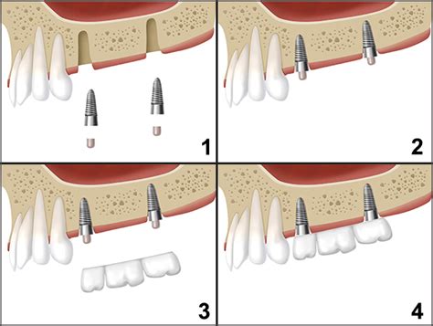 Implant-Supported Dental Bridges, Gosford: VC Dental