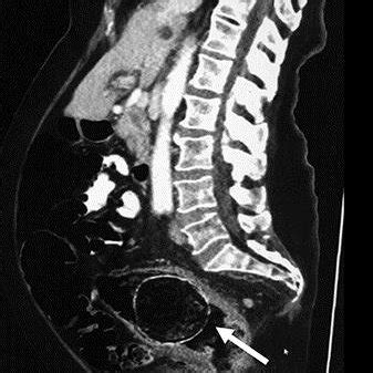 (PDF) Giant Fecalith Causing Near Intestinal Obstruction and Rectal Ischemia