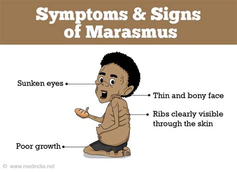 Marasmus | Protein-Energy Malnutrition - Causes, Symptoms, Diagnosis, Treatment and Prevention