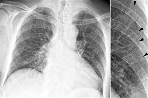 Get Inspired For What Does Pneumonia Look Like On X Ray