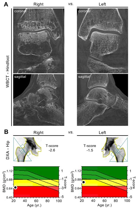 Local deterioration of bone mass after fracture and subsequent... | Download Scientific Diagram