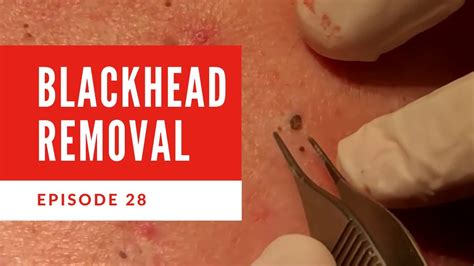 Blackhead Removal on back and excellent blackhead extraction EP28 - YouTube