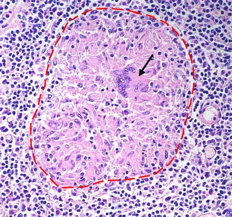 How do histologists diagnose tuberculosis? | Histology Blog