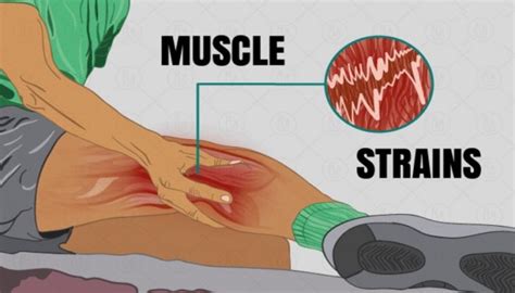 Muscle Strain Physiotherapy Treatment | Physiotherapy Clinic Dubai