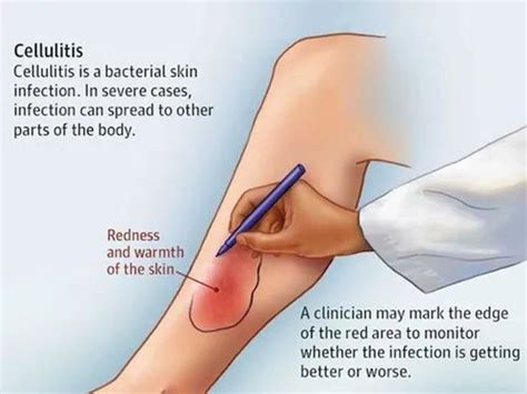 Cellulitis Treatment in Madurai | ID: 21015583388