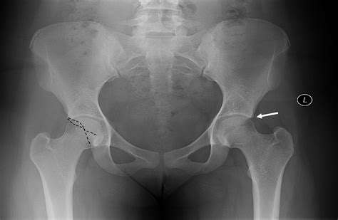 Femoroacetabular Impingement Article