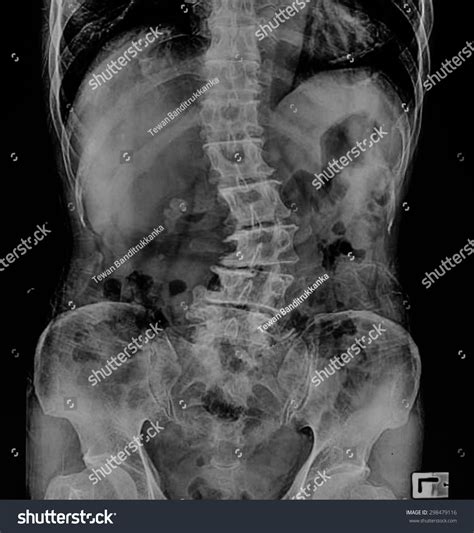 Scoliosis Film Xray Lumbar Spine Ap Stock Photo 298479116 | Shutterstock