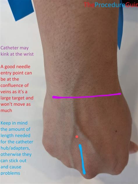 Peripheral Intravenous Access (IV) Technique Quick Guide - The ...